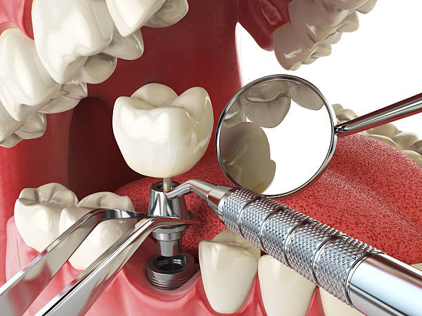 Best Emergency Wisdom Teeth Removal in Zion, IL